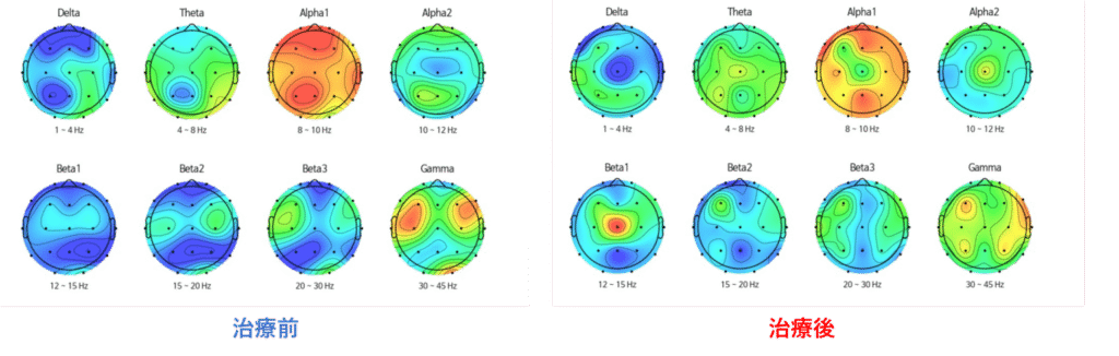 QEEG（脳波検査）による治療前後の比較