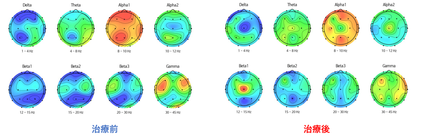 QEEG（定量的脳波検査）によるTMS治療前と治療後の脳波解析結果を並べて比較した画像